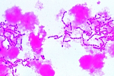 Mikropräparat - Streptococcus pyogenes, Sepsis, Ausstrich mit kurzen Ketten