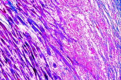 Mikropräparat - Leistenhoden mit Hyperplasie der Leydigschen Zellen
