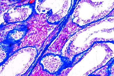 Mikropräparat - Karzinom am Hals der Gebärmutter, Carcinoma cervicis uteri