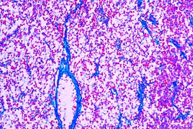 Mikropräparat - Hodengeschwulst, Sarcoma testis