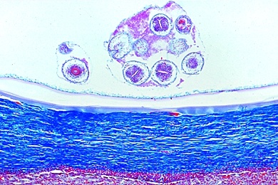 Mikropräparat - Echinococcus multilocularis, Bandwurm, Zystenwand (Hydatide) mit Tochterblasen und Scolices aus infizierter Leber, quer