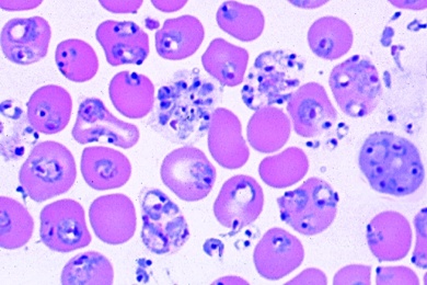 Mikropräparat - Plasmodium, Erreger der Malaria, versch. Stadien im Blutausstrich