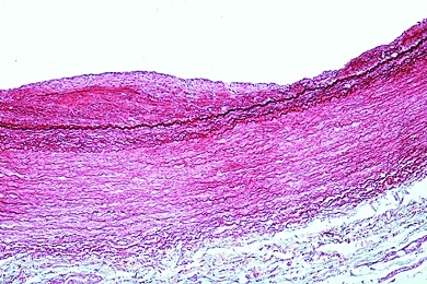 Mikropräparat - Arterienverkalkung des Menschen, quer. Ablagerungen innerhalb der Blutgefäße