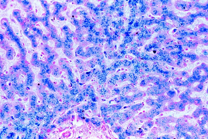 Mikropräparat - Hämosiderosis der Leber. Berlinerblau-Reaktion, Krankhafte Veränderungen der Zellen und Gewebe