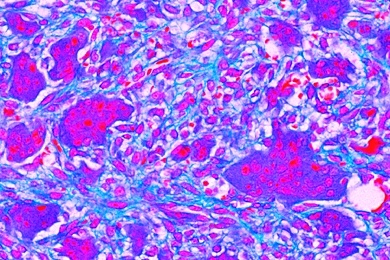 Mikropräparat - Riesenzellen-Granulom des Oberkiefers, Epulis giganto-cellularis