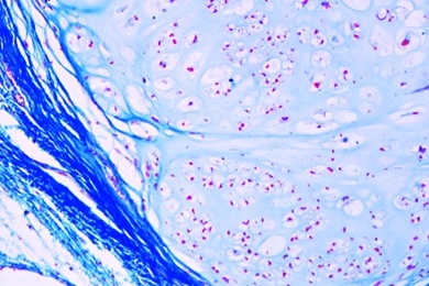 Mikropräparat - Knorpelgeschwulst des Schambeins (Chondrom), Histologie der gut- und bösartigen Geschwülste