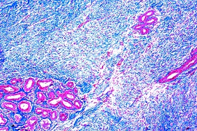 Mikropräparat - Geschwulst der Brustdrüse, Fibroadenoma mammae
