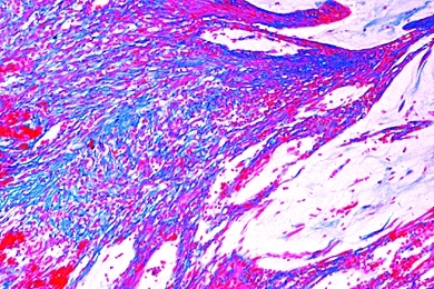 Mikropräparat - Gallertkrebs des Mastdarms, Carcinoma gelatinosum recti