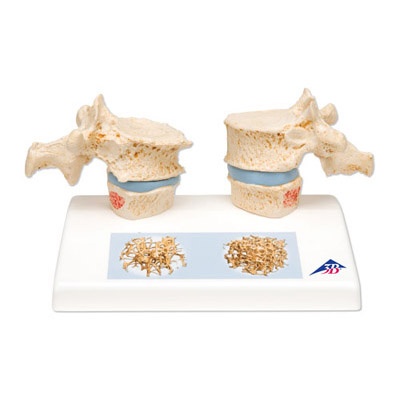 Osteoporose Modell