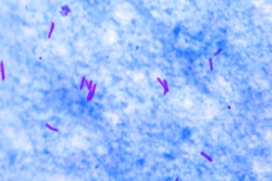 Mikropräparat - Mycobacterium tuberculosis, Tuberkulose, Ausstrich
