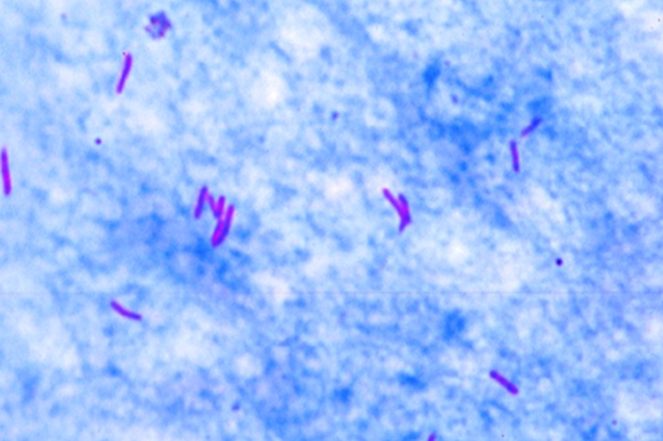 Mikropräparat - Mycobacterium tuberculosis. Ausstrich vom positiven Sputum. Färb