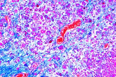 Mikropräparat - Riesenzellensarkom des Oberkiefers