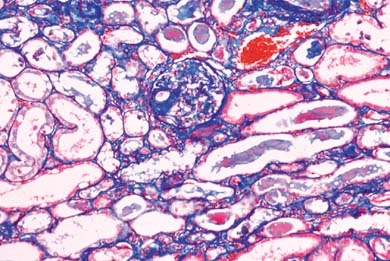 Mikropräparat - Amyloid-Degeneration der Niere (A myloidose)