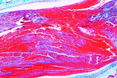 Mikropräparat - Organisierte Venentrombose im Wadenmuskel