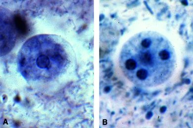 Mikropräparat - Entamoeba histolytica, Erreger der Amöbenruhr des Menschen, Stuhlausstrich