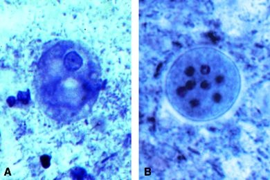 Mikropräparat - Entamoeba coli, nichtpathogener Darmbewohner des Menschen. Stuhlausstrich